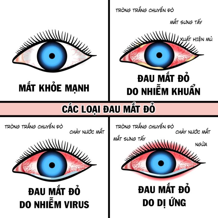 TRUYỀN THÔNG PHÒNG CHỐNG BỆNH ĐAU MẮT ĐỎ
